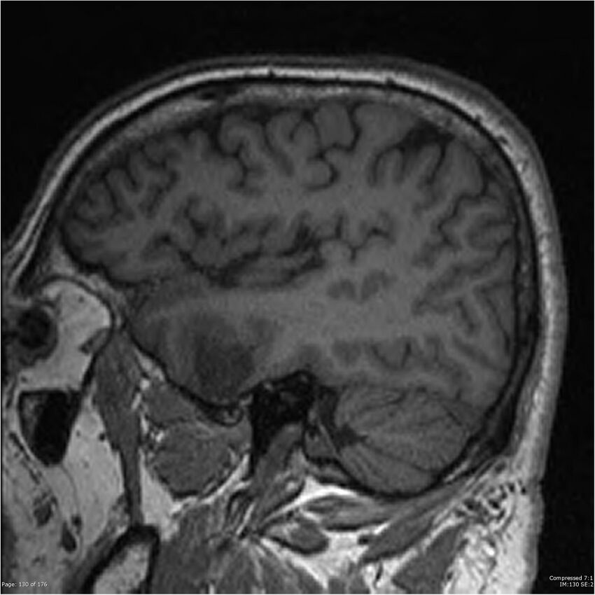 Chondrosarcoma of skull base- grade II (Radiopaedia 40948-43654 Sagittal T1 53).jpg