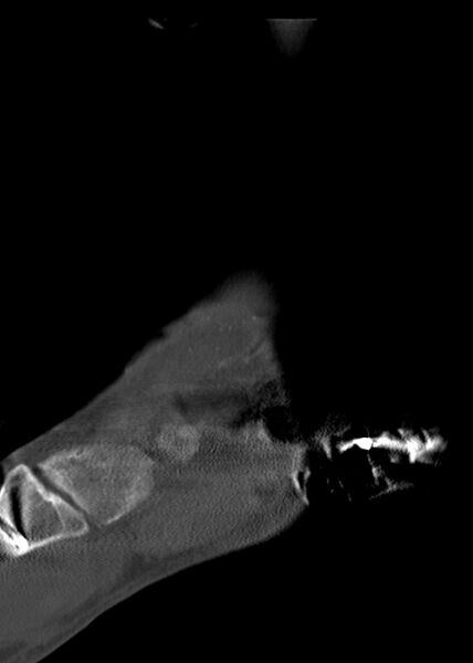 File:Chopart fracture (Radiopaedia 35347-36861 Sagittal bone window 26).jpg