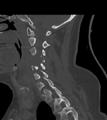 Chordoma (C4 vertebra) (Radiopaedia 47561-52188 Sagittal bone window 47).png