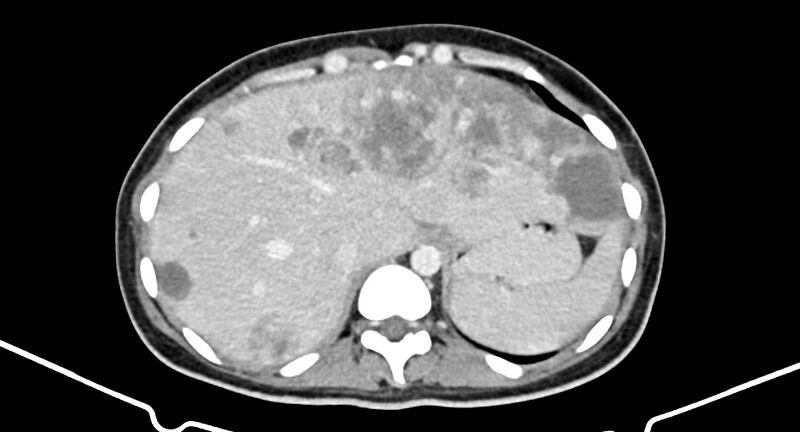 File:Choriocarcinoma liver metastases (Radiopaedia 74768-85766 A 44).jpg