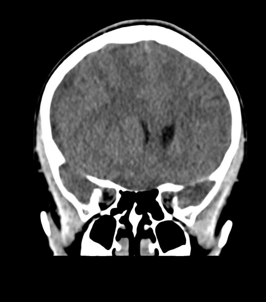 Choroid plexus carcinoma (Radiopaedia 91013-108552 Coronal non-contrast 28).jpg