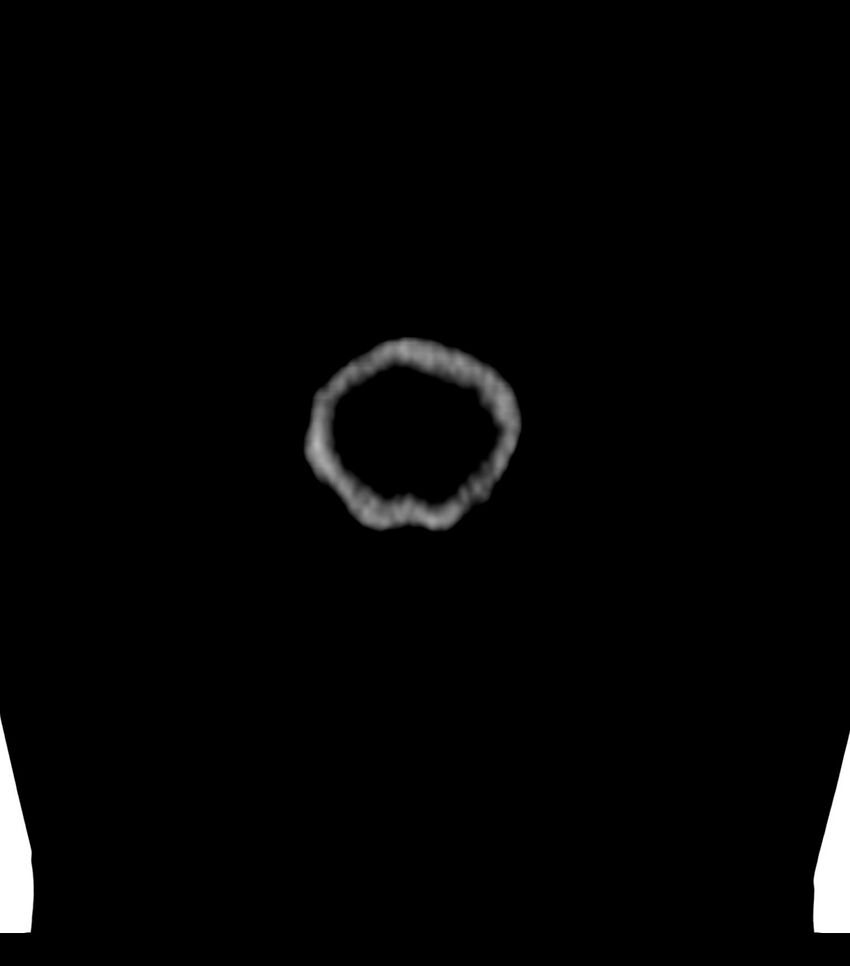 Choroid plexus carcinoma (Radiopaedia 91013-108552 Coronal non-contrast 90).jpg