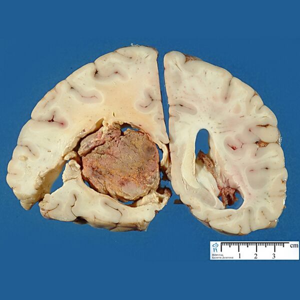 File:Choroid plexus carcinoma (gross pathology) (Radiopaedia 27639).jpg