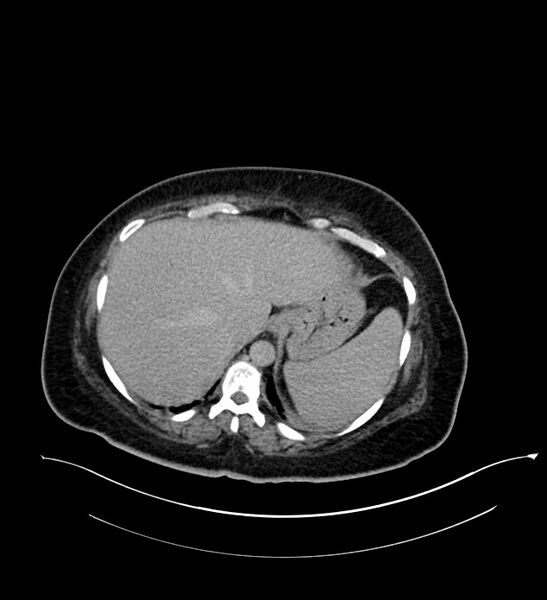 File:Chromophobe renal cell carcinoma (Radiopaedia 84239-99519 E 36).jpg
