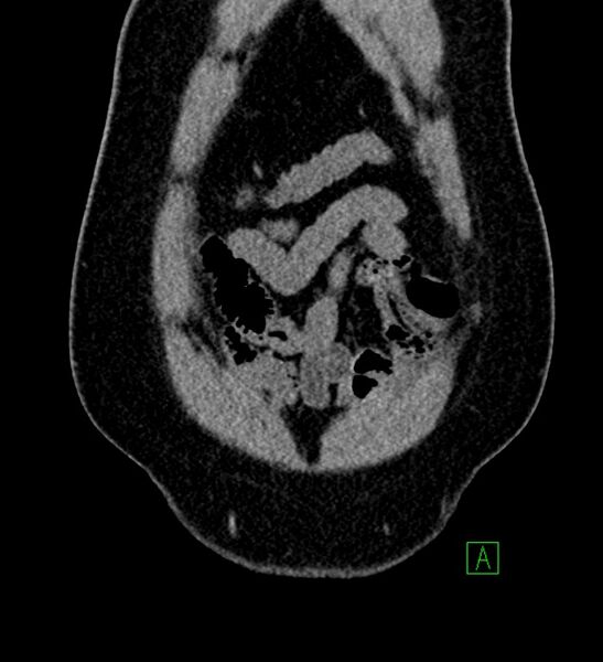 File:Chromophobe renal cell carcinoma (Radiopaedia 84286-99573 Coronal non-contrast 19).jpg