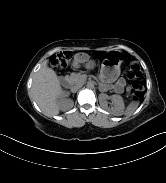 File:Chromophobe renal cell carcinoma (Radiopaedia 84290-99582 Axial non-contrast 48).jpg