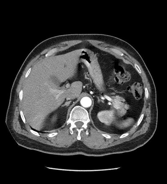 File:Chromophobe renal cell carcinoma (Radiopaedia 86879-103083 B 36).jpg