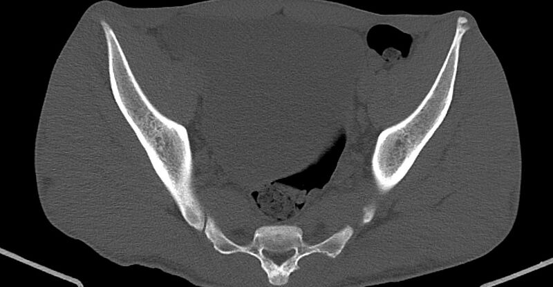 File:Chronic osteomyelitis (with sequestrum) (Radiopaedia 74813-85822 Axial non-contrast 19).jpg