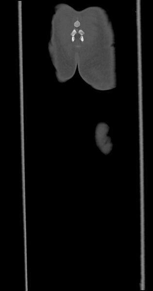 File:Chronic osteomyelitis (with sequestrum) (Radiopaedia 74813-85822 Coronal non-contrast 57).jpg