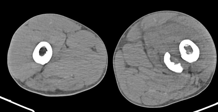 Chronic osteomyelitis (with sequestrum) (Radiopaedia 74813-85822 D 80).jpg