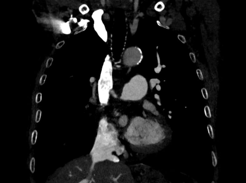 File:Chronic pulmonary embolism (Radiopaedia 91241-108843 A 46).jpg