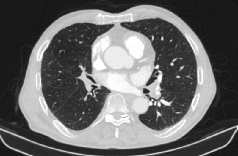 File:Chronic pulmonary embolism (Radiopaedia 91241-108843 Axial lung window 49).jpg
