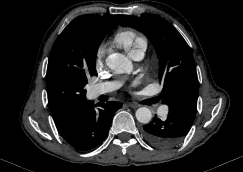 File:Chronic pulmonary embolism with bubbly consolidation (Radiopaedia 91248-108850 C+ arterial phase 77).jpg