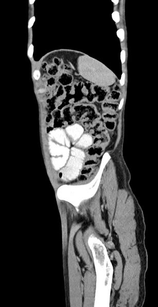 File:Chronic small bowel volvulus (Radiopaedia 75224-86322 C 27).jpg