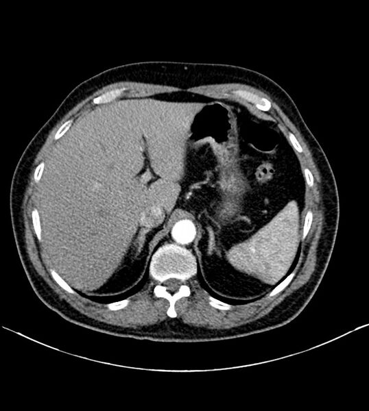 File:Clear cell renal cell carcinoma (Radiopaedia 85006-100539 B 24).jpg