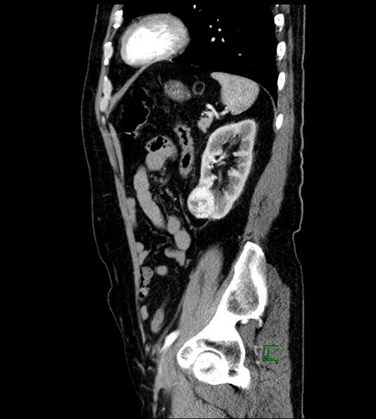 File:Clear cell renal cell carcinoma (Radiopaedia 85006-100539 E 16).jpg