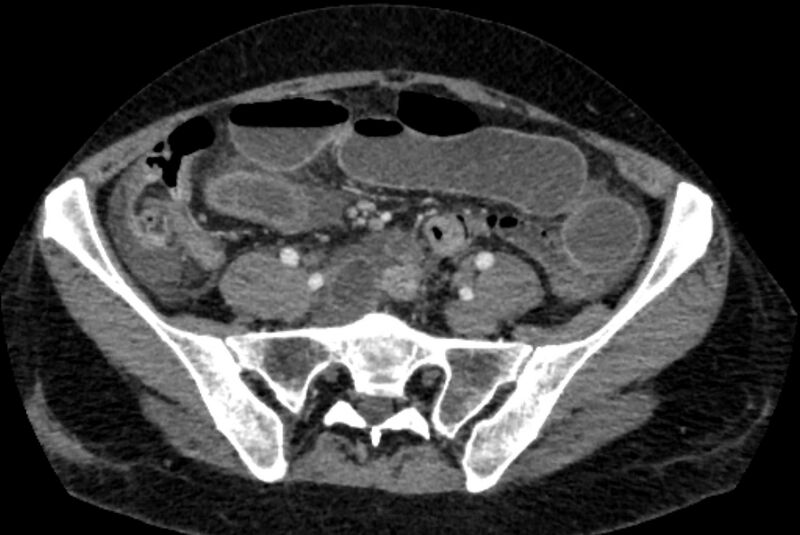 File:Closed loop small bowel obstruction (Radiopaedia 71211-81508 A 105).jpg