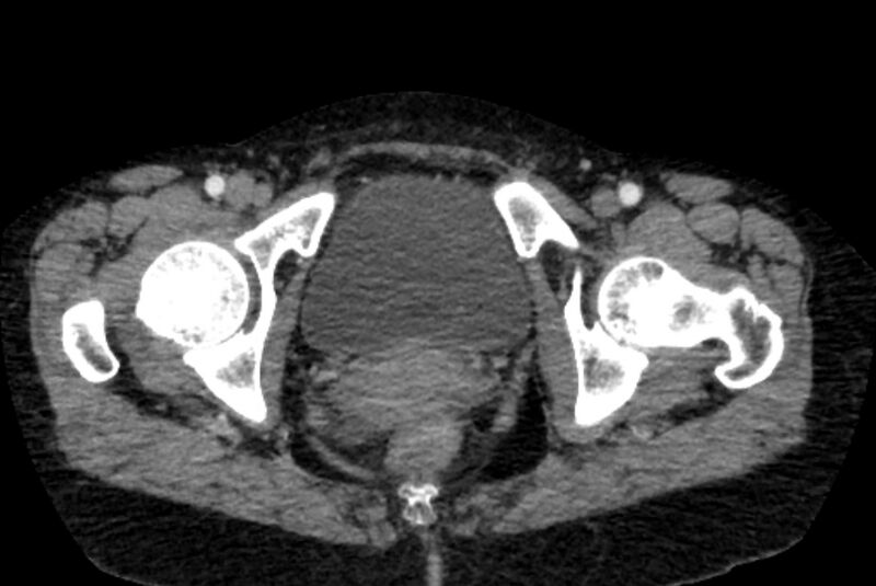 File:Closed loop small bowel obstruction (Radiopaedia 71211-81508 A 168).jpg