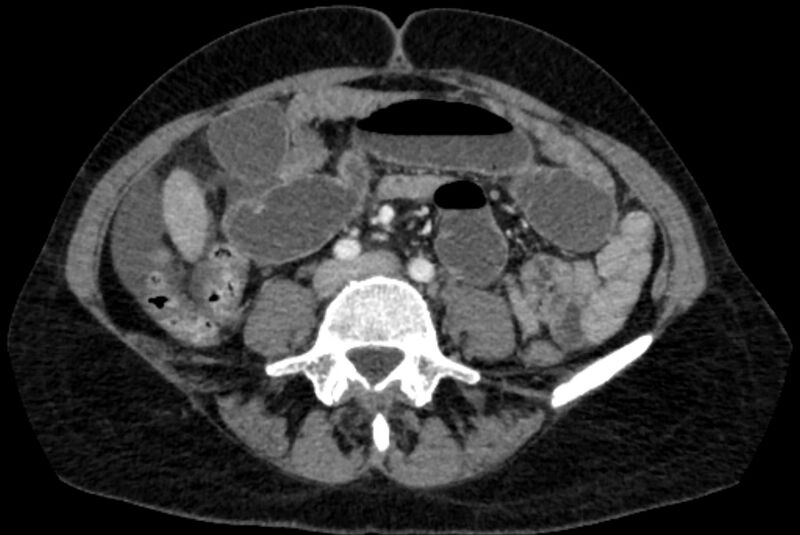 File:Closed loop small bowel obstruction (Radiopaedia 71211-81508 A 78).jpg