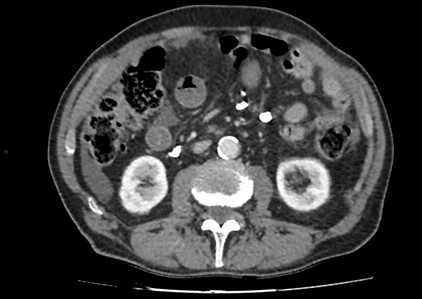 Closed loop small bowel obstruction with ischemia (Radiopaedia 84180-99456 A 55).jpg