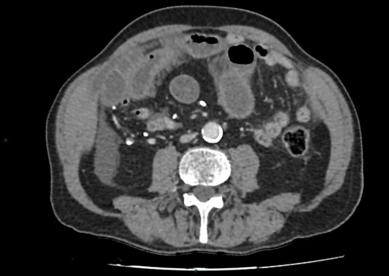 File:Closed loop small bowel obstruction with ischemia (Radiopaedia 84180-99456 A 63).jpg