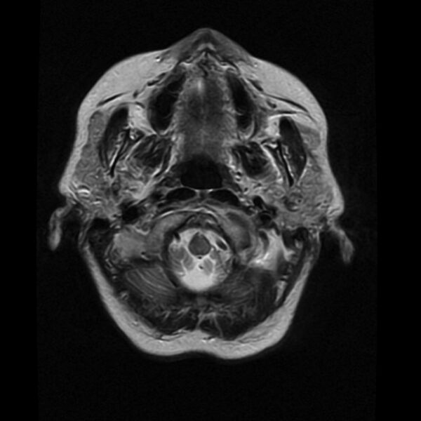 File:Colloid cyst with hydrocephalus (Radiopaedia 9373-10065 Axial T2 1).jpg