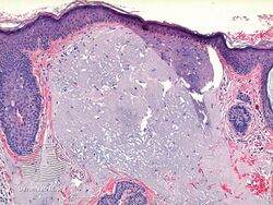 Favre–Racouchot syndrome-pathology