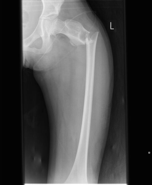 File:Fracture through unicameral bone cyst (Radiopaedia 20002).jpg