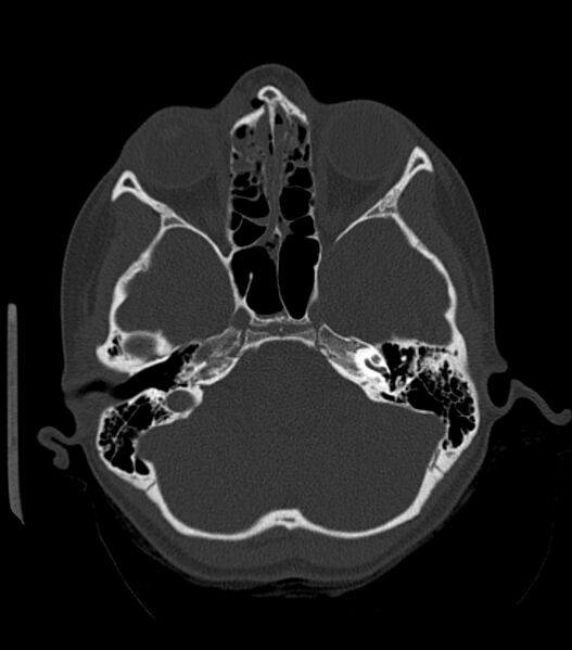 File:Nasoorbitoethmoid fracture (Radiopaedia 90044-107205 Axial bone window 79).jpg