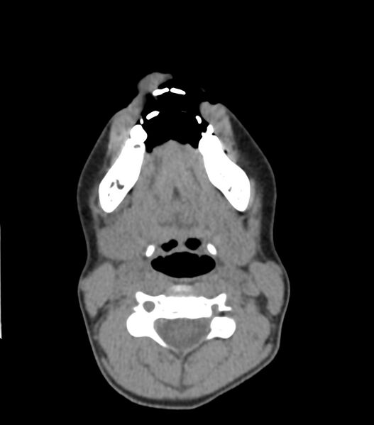 File:Nasoorbitoethmoid fracture (Radiopaedia 90044-107205 Axial non-contrast 57).jpg