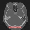 Nasopharyngeal carcinoma recurrence - skull base destruction (Radiopaedia 29107-29490 Axial bone window 77).jpg