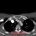 Nasopharyngeal carcinoma recurrence - skull base destruction (Radiopaedia 29107-29491 A 41).jpg