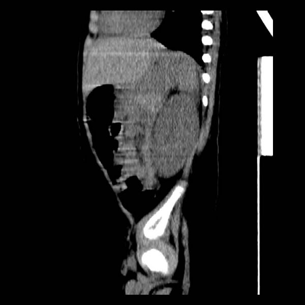 File:Neuroblastoma with skull metastases (Radiopaedia 30326-30960 B 32).jpg
