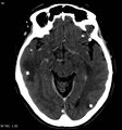 Neurocysticercosis (Radiopaedia 7773-8596 C+ delayed 4).jpg