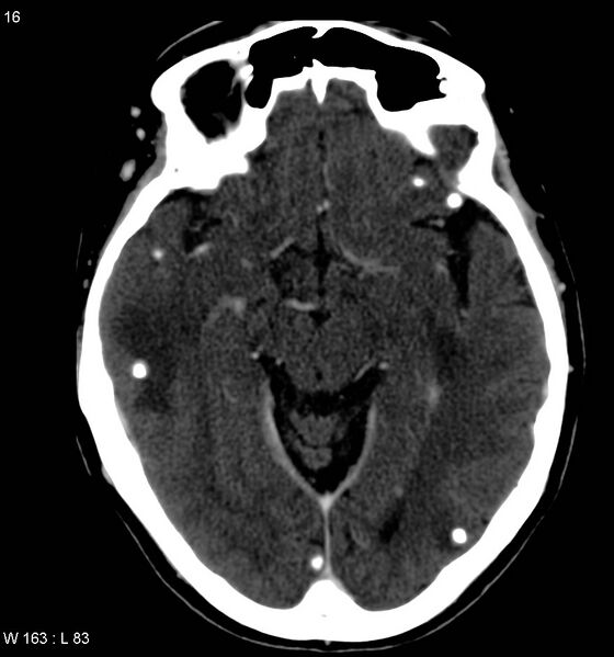 File:Neurocysticercosis (Radiopaedia 7773-8596 C+ delayed 4).jpg