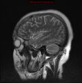 Neuroglial cyst (Radiopaedia 10713-11184 Sagittal T2 5).jpg