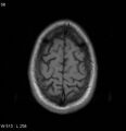 Neurosarcoidosis (Radiopaedia 10930-17204 Axial T1 18).jpg