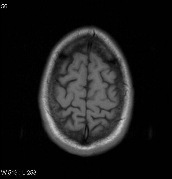 File:Neurosarcoidosis (Radiopaedia 10930-17204 Axial T1 18).jpg
