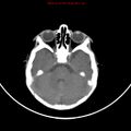 Non-accidental injury - bilateral subdural with acute blood (Radiopaedia 10236-10765 Axial non-contrast 6).jpg