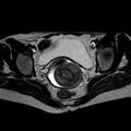 Non-puerperal uterine inversion (Radiopaedia 78343-90983 Axial T2 19).jpg