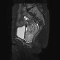 Non-puerperal uterine inversion (Radiopaedia 78343-90983 Sagittal T2 fat sat 12).jpg