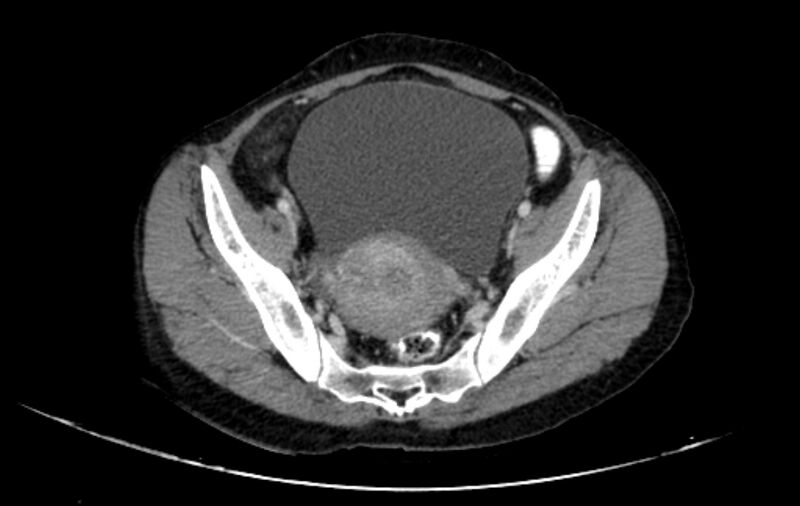 File:Non-puerperal uterine inversion (Radiopaedia 78343-91094 A 11).jpg