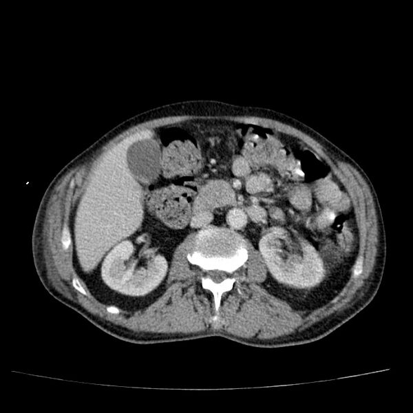 File:Non small-cell lung cancer (Radiopaedia 24467-24769 C+ delayed 74).jpg