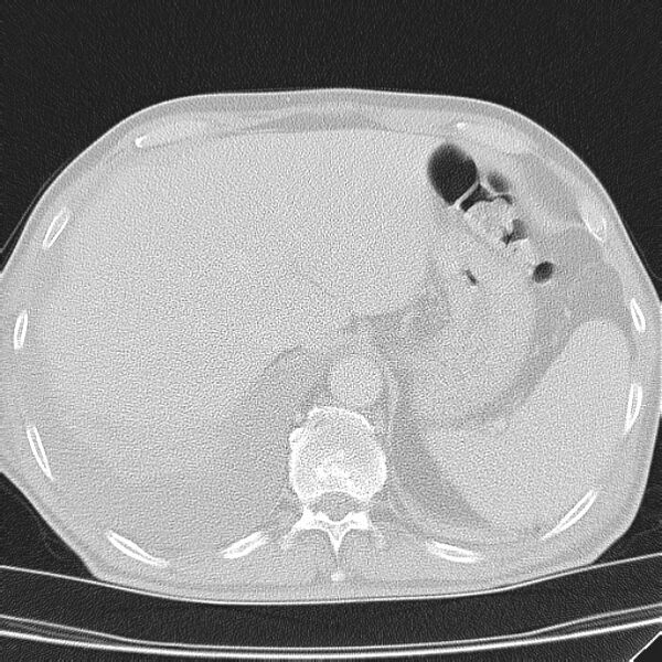 File:Non small-cell lung cancer (Radiopaedia 24467-24769 lung window 49).jpg