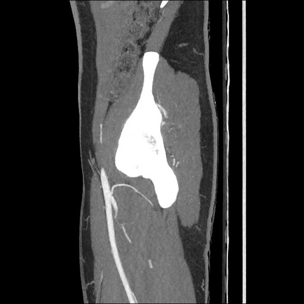File:Normal CT angiogram of pelvis (Radiopaedia 45390-49430 C 53).jpg