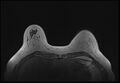 Normal breast MRI - dense breasts (Radiopaedia 80454-93850 Axial T1 49).jpg