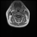 Normal cervical and thoracic spine MRI (Radiopaedia 35630-37156 Axial T1 C+ 21).png