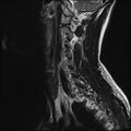Normal cervical spine MRI (Radiopaedia 38418-40496 Sagittal T2 3).jpg