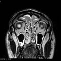 Normal coronal brain (Radiopaedia 6676-7910 Coronal T2 2).jpg