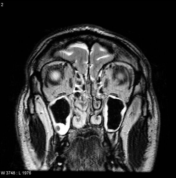 File:Normal coronal brain (Radiopaedia 6676-7910 Coronal T2 2).jpg